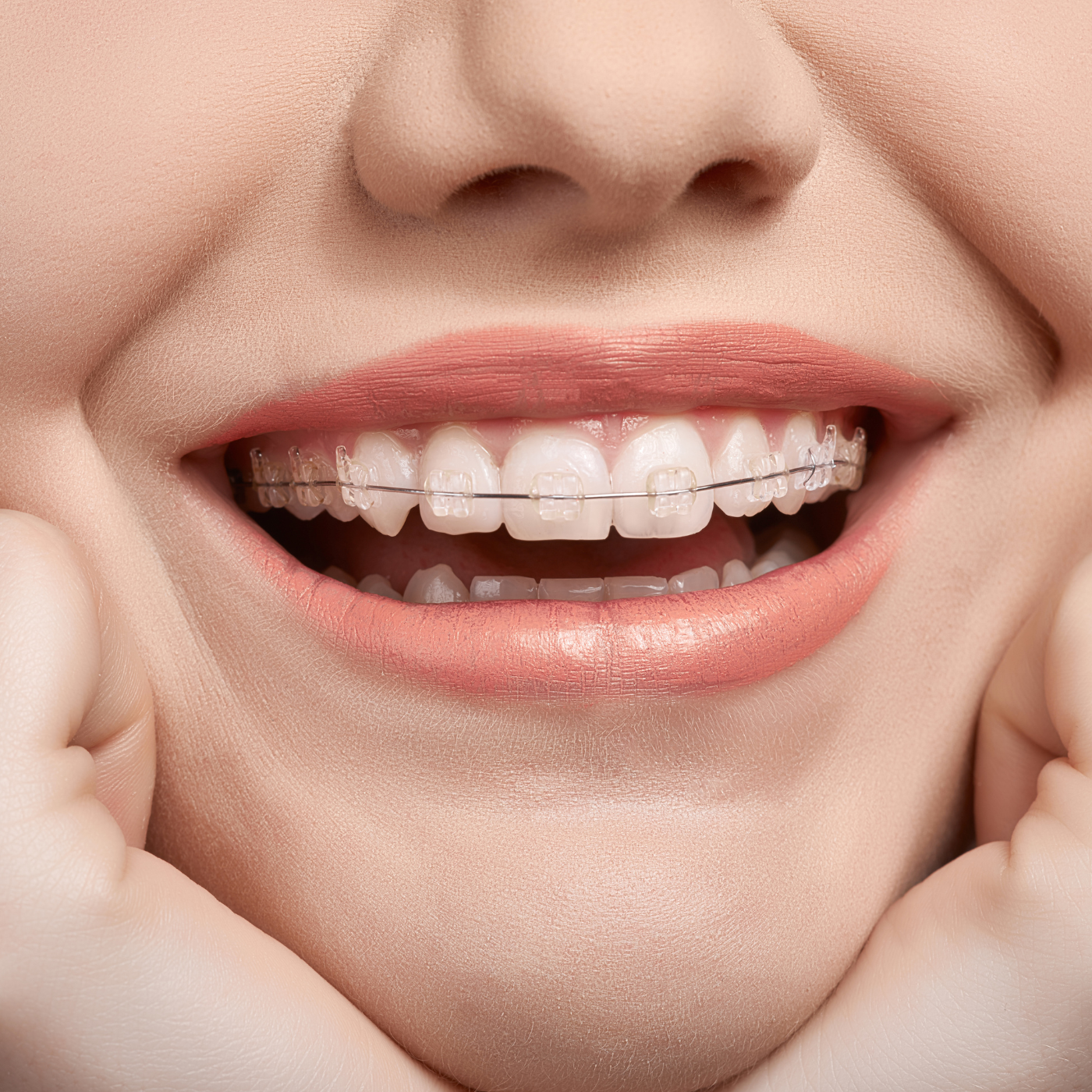 Clear braces