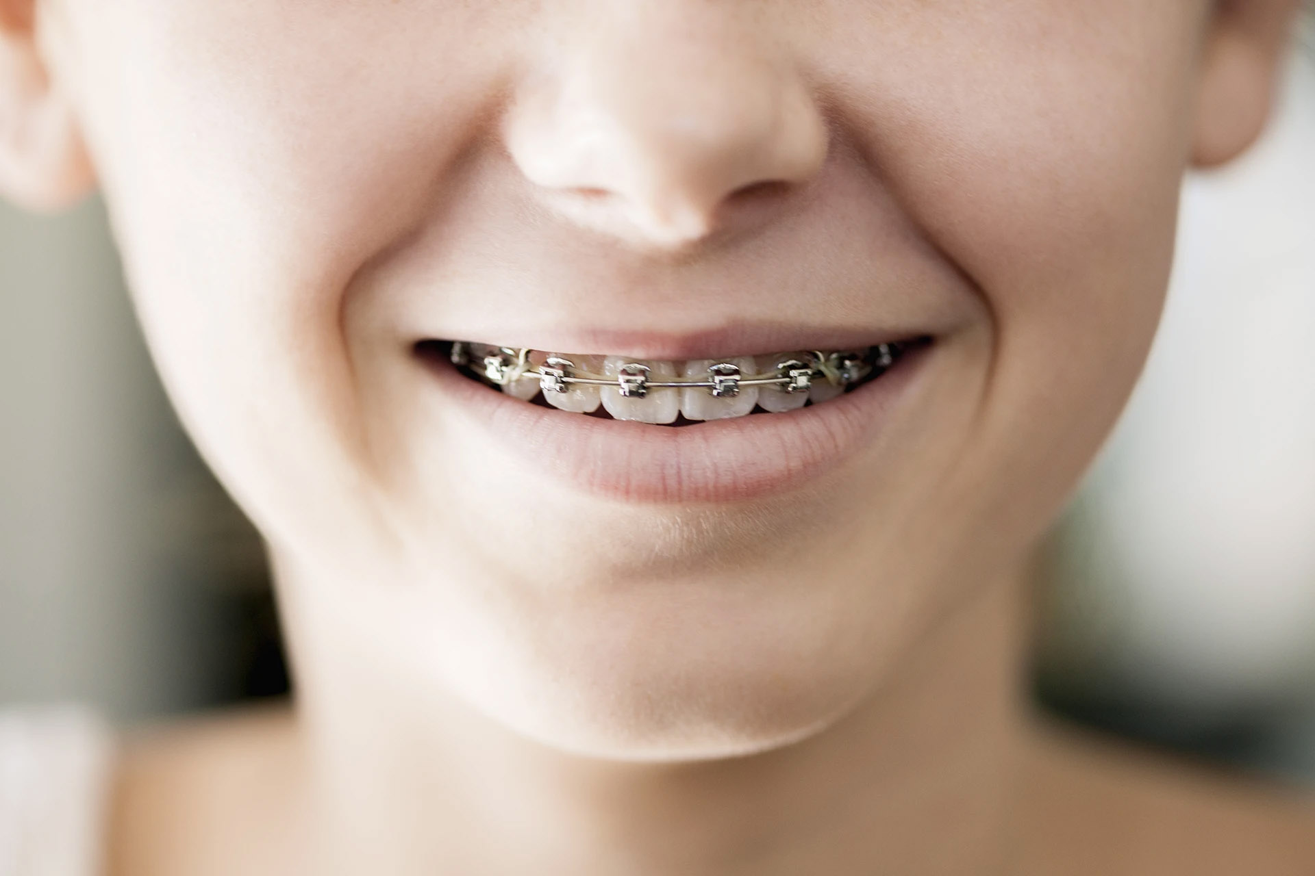 Close-up of a smiling mouth wearing metal braces