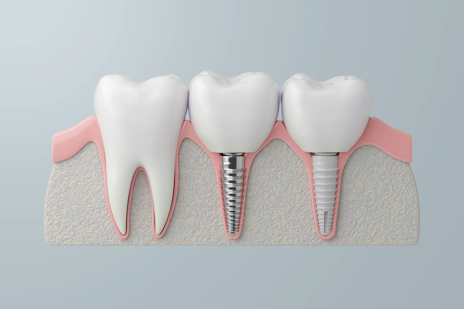 Three-dimensional cross-section illustration showing dental implants in the jawbone beside a natural tooth