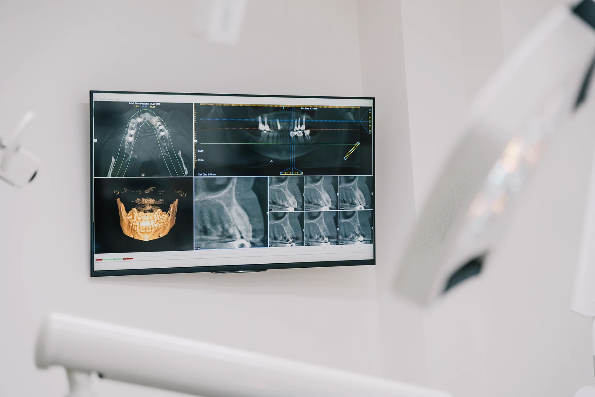 Wall monitor displaying CBCT implant-planning software with panoramic, axial and 3D views of the jaw