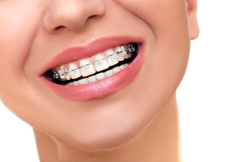 A smile clear braces, close-up
