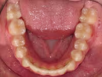 Bonded retainer lower arch intraoral